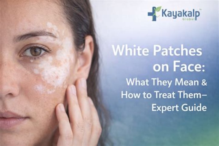 What is the natural remedy for white patches on face?