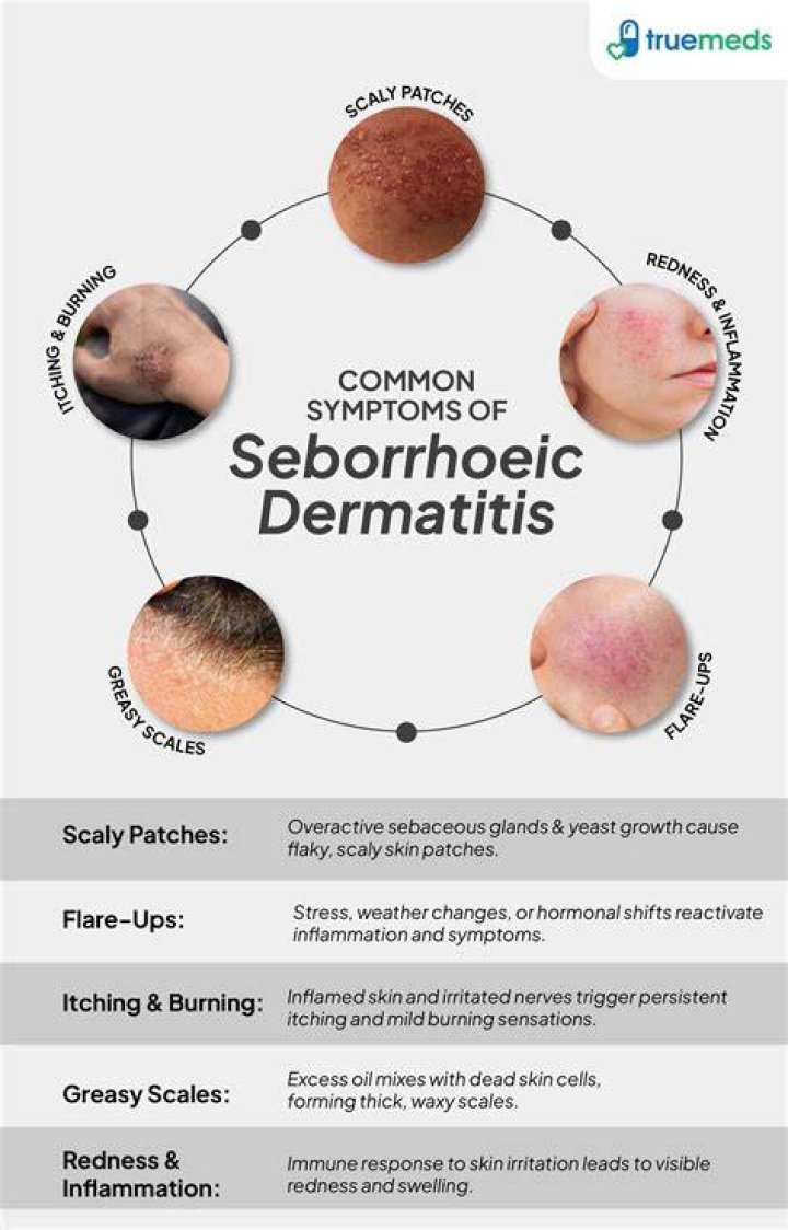 What kills seborrheic dermatitis?