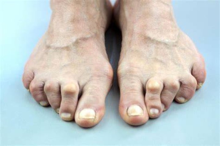 What kind of shoes should I wear if I have arthritis in my toes?