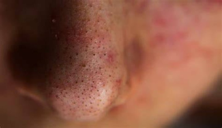 What will draw blackheads out?