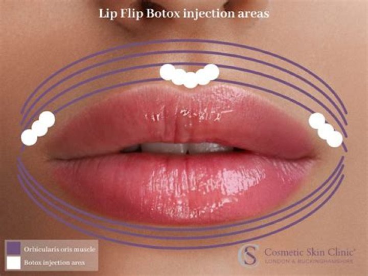 Where do you inject Botox to flip your lips?
