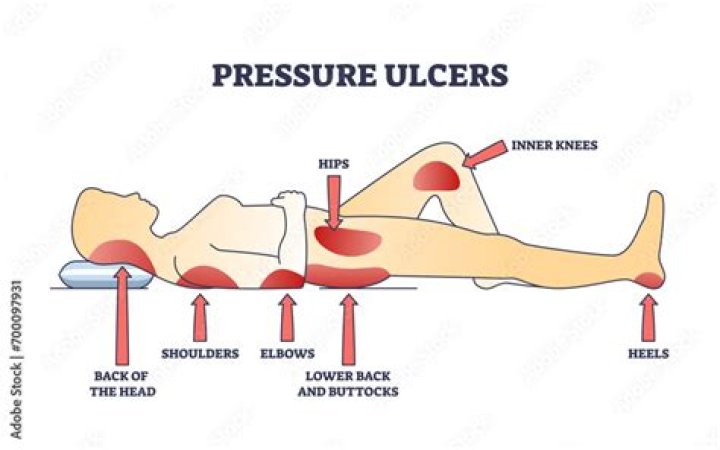 Where is ulcer pain felt left or right?