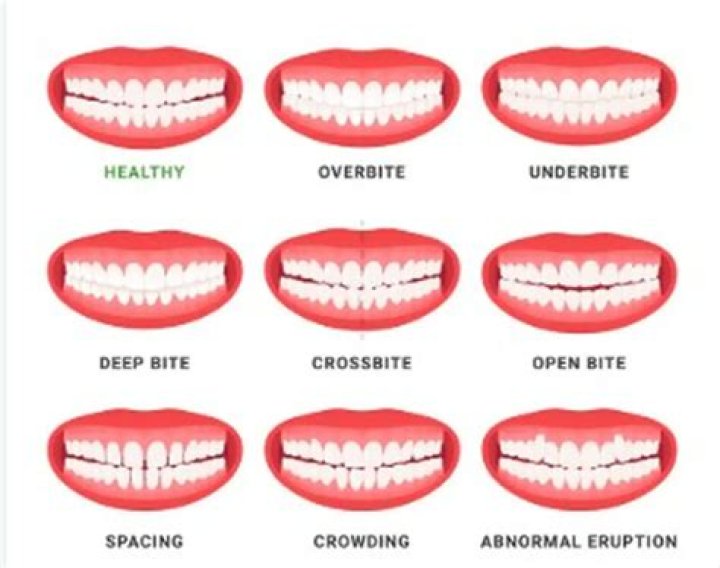 Why are crooked teeth so common?