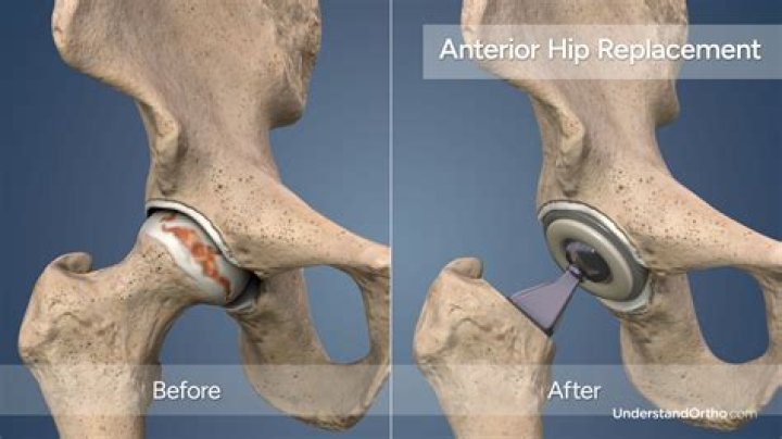 Why do I waddle after hip replacement surgery?