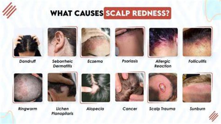 Why does my head bleed when I scratch dandruff?